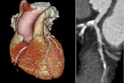 Example images from a coronary CT angiogram with 3D reconstruction and curved planar reconstruction of the left anterior descending coronary artery showing severe coronary artery disease. Courtesy of Prof. Michelle Williams and SCOT-HEART.