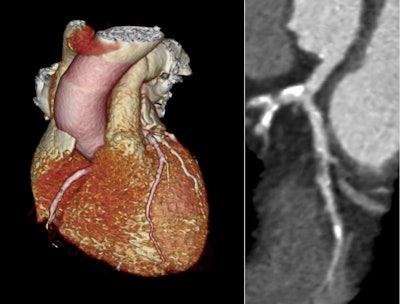 Example images from a coronary CT angiogram with 3D reconstruction and curved planar reconstruction of the left anterior descending coronary artery showing severe coronary artery disease. Courtesy of Prof. Michelle Williams and SCOT-HEART.