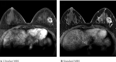 Ultrafast and standard MRI in a 30-year-old woman with triple-negative invasive ductal carcinoma. (A) Ultrafast MRI taken 16.8 seconds after contrast agent injection. (B) Standard MRI taken 58.8 seconds after contrast agent injection. Both images show an oval-shaped, irregular marginated, rim-enhancing mass in the left outer breast. For 3D tumor segmentation, the entire enhanced tumor margins were drawn from top to bottom of each tumor in axial views of U2 phase postcontrast ultrafast MRI and the initial phase postcontrast standard MRI. Among the 14 ultrafast images, U1 is the first phase in which the signal intensity of the hotspot region of interest of the tumor is 10% higher than the average signal intensity of unenhanced images. U2 is the immediate next phase of U1 and the well-established tumor enhancement time.