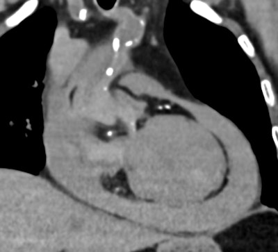Postmortem CT reveals a large-volume hemopericardium caused by myocardial rupture, providing a definitive cause of death and avoiding the need for an invasive autopsy. All images courtesy of Drs. Susan Shelmerdine and Natasha Davendralingam.