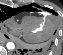 Postmortem CT with coronary angiography and positive contrast highlights the precise location of myocardial rupture within the left ventricular wall, showcasing the value of contrast-enhanced imaging in providing accurate diagnoses without the need for autopsy.
