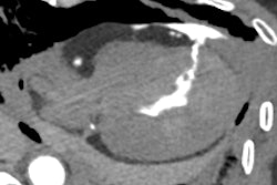 Postmortem CT with coronary angiography and positive contrast highlights the precise location of myocardial rupture within the left ventricular wall, showcasing the value of contrast-enhanced imaging in providing accurate diagnoses without the need for autopsy.