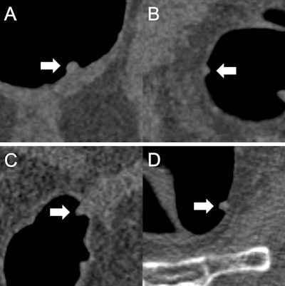 (A) A 9 mm tubular adenoma that was classified by all readers as 'polypectomy: yes.' The initial recommendation was confirmed based on the prediction 'adenomatous' of the AI model. (B) A 6 mm hyperplastic polyp that was classified by all readers as 'polypectomy: no.' The initial recommendation was confirmed based on the prediction 'nonadenomatous' of the AI model. (C) An 8 mm tubular adenoma that was classified by three readers as 'polypectomy: no.' The initial recommendation was corrected by all three readers based on the prediction 'adenomatous' of the AI model. (D) A 7 mm hyperplastic polyp that was classified by two readers as 'polypectomy: yes.' The initial recommendation was corrected by both readers based on the prediction 'nonadenomatous' of the AI model. All figures courtesy of Dr. Sergio Grosu et al and European Radiology.