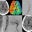 Images in a 74-year-old male patient who presented at the hospital with acute symptoms of a right hemispheric ischemic stroke and a National Institutes of Health Stroke Scale (NIHSS) score of 24. (A) Nonenhanced CT image shows no signs of early infarction, whereas (B) CT perfusion image shows a large perfusion deficit in the territory of the middle cerebral artery and anterior cerebral artery caused by an extracranial occlusion in the right internal carotid artery. (C) Digital subtraction angiography shows the occlusion in the C1 segment. The extracranial occlusion was passed, reperfused, and subsequently stented (D, E). The final contrast injection did not reveal any intracranial occlusions within the territory of the internal carotid artery (F). At the 24-hour follow-up, there was no infarction on (G) the nonenhanced CT image, and the NIHSS score had decreased to 3 points. Image courtesy of RSNA.