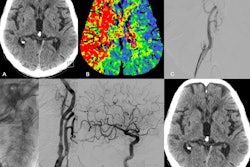 Images in a 74-year-old male patient who presented at the hospital with acute symptoms of a right hemispheric ischemic stroke and a National Institutes of Health Stroke Scale (NIHSS) score of 24. (A) Nonenhanced CT image shows no signs of early infarction, whereas (B) CT perfusion image shows a large perfusion deficit in the territory of the middle cerebral artery and anterior cerebral artery caused by an extracranial occlusion in the right internal carotid artery. (C) Digital subtraction angiography shows the occlusion in the C1 segment. The extracranial occlusion was passed, reperfused, and subsequently stented (D, E). The final contrast injection did not reveal any intracranial occlusions within the territory of the internal carotid artery (F). At the 24-hour follow-up, there was no infarction on (G) the nonenhanced CT image, and the NIHSS score had decreased to 3 points. Image courtesy of RSNA.