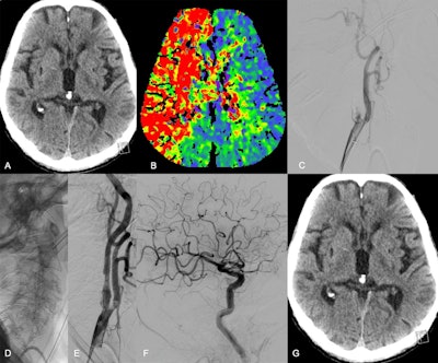 Images in a 74-year-old male patient who presented at the hospital with acute symptoms of a right hemispheric ischemic stroke and a National Institutes of Health Stroke Scale (NIHSS) score of 24. (A) Nonenhanced CT image shows no signs of early infarction, whereas (B) CT perfusion image shows a large perfusion deficit in the territory of the middle cerebral artery and anterior cerebral artery caused by an extracranial occlusion in the right internal carotid artery. (C) Digital subtraction angiography shows the occlusion in the C1 segment. The extracranial occlusion was passed, reperfused, and subsequently stented (D, E). The final contrast injection did not reveal any intracranial occlusions within the territory of the internal carotid artery (F). At the 24-hour follow-up, there was no infarction on (G) the nonenhanced CT image, and the NIHSS score had decreased to 3 points. Image courtesy of RSNA.