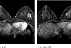 2025 01 25 Breast Mri Ultrafast Standard