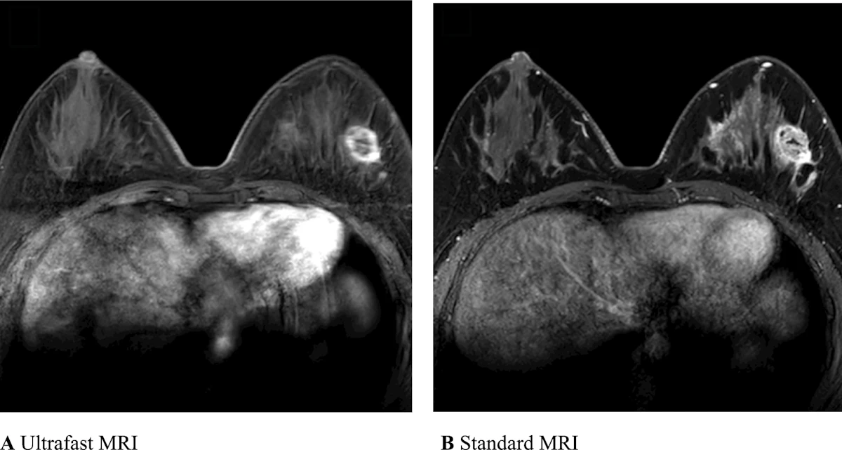 Ultrafast MRI proves value for classifying breast cancers ...