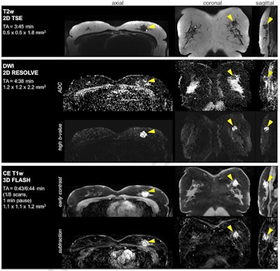 Figure 1. Clinical breast cancer patient data set acquired with the BraCoil in the supine position. MRI shows a 22 mm mass lesion diagnosed as invasive ductal carcinoma. Coronal slice acquisition (i.e., highest in-plane resolution) was used in T2-weighted and diffusion-weighted imaging; axial slice acquisition in dynamic contrast-enhanced T1-weighed imaging. In this patient, the full protocol duration (including localizer scan) was 15 minutes 20 seconds, and seven postcontrast scans were enabled by high parallel imaging acceleration (R = 3 x 3). All figures courtesy of Lena Nohava, PhD, Elmar Laistler, PhD, et al, and EJR.