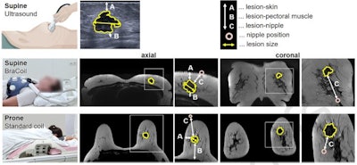 Figure 2. Breast ultrasound and MRI setups and measured distances for lesion description. Lesion skin, lesion-pectoral muscle, lesion-nipple distances (A, B, and C), and lesion size were measured in axial. Lesion-nipple distance was additionally measured in coronal orientation. All distances were taken from the border of the lesion. They represent the shortest distance between the two points in axial and coronal, respectively. In coronal, the lesion-nipple distance is the projected distance also indicating the quadrant. The patient case is identical to the one shown in Figure 1.
