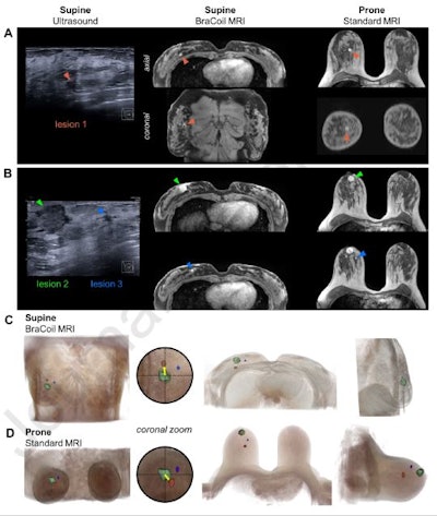 Figure 3. Ultrasound and early contrast-enhanced T1-weighted MRI of a 43-year-old patient (European bra size 85C, U.S. bra size 38 C) diagnosed with multicentric invasive ductal carcinomas -- (A) lesion 1: 6 mm, (B) lesion 2: 20 mm, lesion 3: 4 mm. Arrows mark the lesion positions. 3D renderings of supine BraCoil (C) and prone standard coil MRI at 1.5 T (D) data illustrate the absolute and relative change in lesion positions. The case shows deviating lesion positions between prone and supine MRI due to breast tissue deformation which occurs especially in larger breasts. Here, the change in distance of the lesion to the nipple or pectoral muscle comparing prone and supine MRI and supine ultrasound is clearly noticeable. The 3D renderings depicted in C and D demonstrate that, e.g., in axial, with the lesion marked in green or the nipple as a reference point, the red lesion appears laterally in supine MRI but medially in prone MRI. The coronal view further reveals that relative to the green lesion, in supine MRI the red lesion is located cranially while in prone MRI it appears caudally.