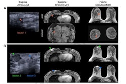 2025 02 01 Ejr Nohava Breast Coil Figure4 Thumbnail2