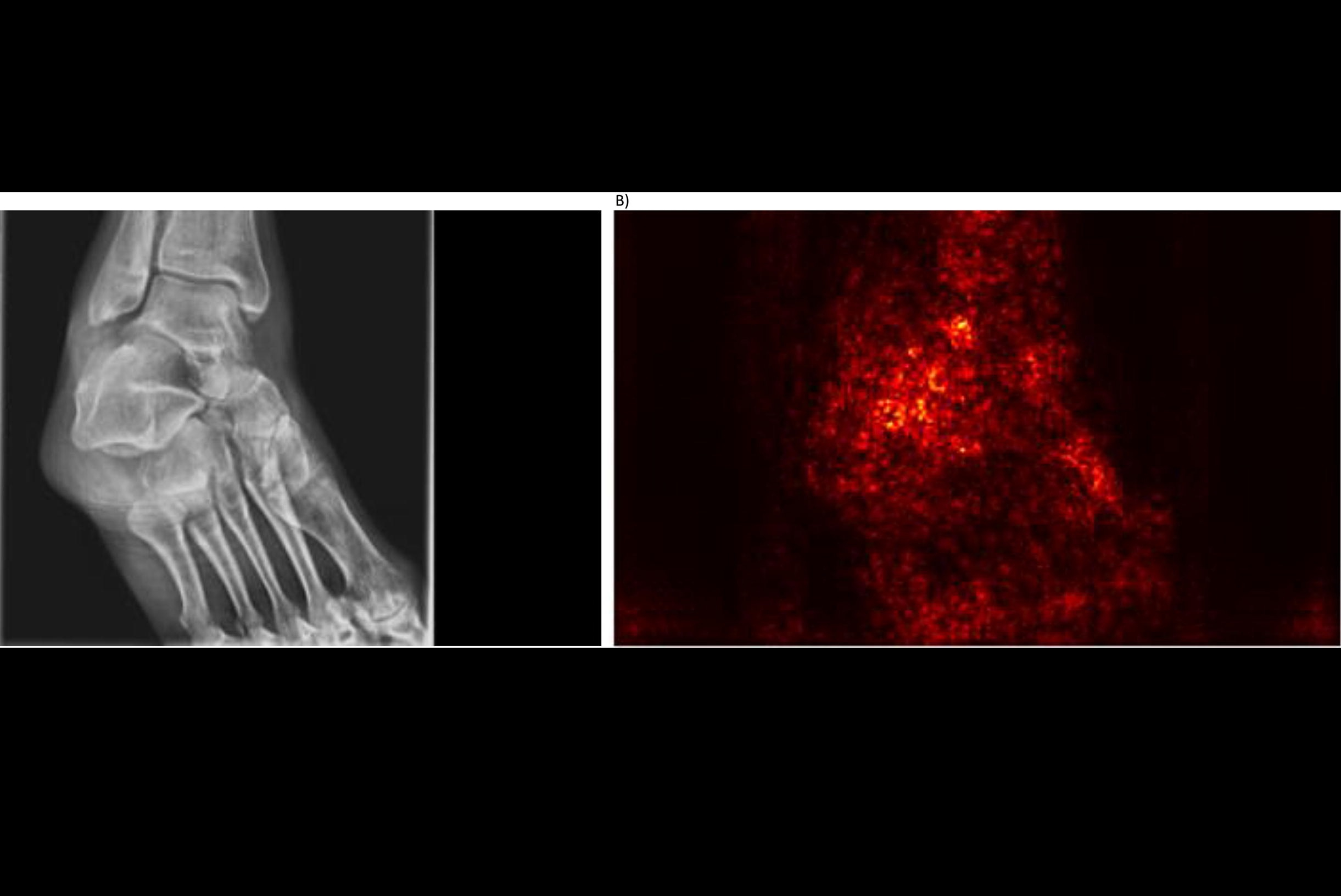2025 02 06 Ankle Osteoporosis