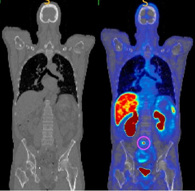 CT image (left) and gallium-68 (Ga-68) PSMA-11 PET/CT (right) showing an identified tumor circled in pink, which is not visible on the CT scan. This modality uses a radioactive tracer that targets tumors by binding to overexpressed PSMA in cancer cells. PSMA PET/CT offers high sensitivity and specificity, with studies showing it has higher detection rates compared to conventional imaging. All figures courtesy of Kaylee Molin, Martin Ebert et al and presented at the Royal Australian and New Zealand College of Radiologists (RANZCR) Annual Scientific Meeting (ASM).