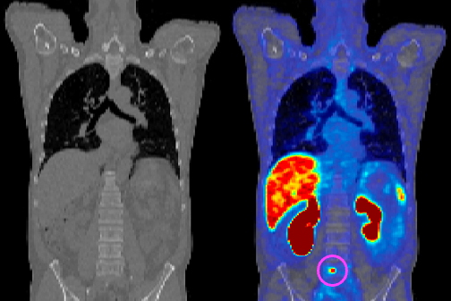 2025 02 13 Fig 1 Pet Ct Of Prostate Thumbnail