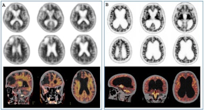 Pitfalls and artifacts in amyloid PET imaging. (A) F-18 florbetapir PET/CT scan of a patient with right frontal stroke and brain atrophy. The PET/CT fusion images clearly show no difference between white matter and grey matter (positive amyloid PET scan). (B) F-18 florbetapir PET/CT scan of a patient with normal pressure hydrocephalus. In this case, the fusion images showed much higher activity in the white matter than in the grey matter (negative amyloid PET scan). All figures courtesy of Angela Bronte, Prof. Javier Arbizu, PhD, et al and European Radiology.