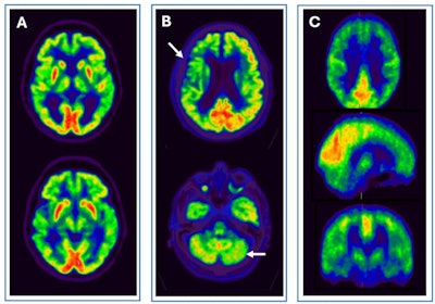 Pitfalls and artifacts in [F-18] FDG PET imaging. (A) Scan of a patient with central nervous system drug interference shows cortical hypometabolism that could mimic an AD pattern, but with thalamic hypometabolism characteristic of this interference. (B) Scan of a patient with a right frontoparietal ischemic antecedent (arrow), showing a diaschisis of the contralateral cerebellum (arrow) due to disruption of the corticospinal tract. (C) An example of a PET scan with motion artifacts.