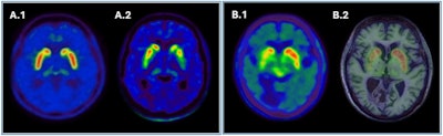 (A) [F-18] FDOPA PET image of a healthy patient (A.1) and a patient with Parkinson's disease (A.2). B: Pitfalls and artifacts in presynaptic dopaminergic imaging. [F-18F] FDOPA PET scan (B.1) of a patient with suspected Parkinson's disease showing a decrease in the right putamen. However, the PET/MRI image (B.2) shows that the decreases are due to the artifact of spaces surrounding the walls of vessels within the brain parenchyma observed on MRI.