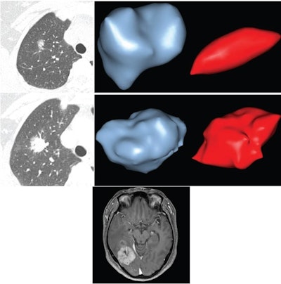 (Top left) Axial image from first chest CT examination shows part-solid nodule in right upper lobe. Diameter of whole nodule is 1.5 cm and of solid component is 0.5 cm. (Top right) Semiautomated 3D segmentations of nodule on first examination, including whole nodule (left) and solid component (right). Volume of whole nodule is 1.07 cm³ and of solid component is 0.02 cm³. Middle left: Axial image from last chest CT examination, performed 42.8 months later. Diameter of whole nodule has increased to 2.6 cm and of solid component has increased to 2.3 cm. (Middle right) Semiautomated 3D segmentations of nodule on last examination, including whole nodule (left) and solid component (right). Volume of whole nodule has increased to 5.2 cm³ and of solid component has increased to 4.4 cm³. VDTw was 565 days (less than neither 200-day or 400-day threshold), and VDTs was 168 days (less than both 200-day and 400-day thresholds). Patient underwent right upper lobectomy 1 day after last CT examination. Pathologic assessment of resected nodule yielded diagnosis of adenocarcinoma with predominant acinar histologic subtype. Pathologic stage was pT1cN0. (Bottom) Axial contrast-enhanced fat-suppressed T1-weighted image from MRI examination of brain performed 3 years postoperatively shows mass in right parietotemporal lobe; mass was resected and found to represent metastatic adenocarcinoma. Patient was confirmed to be alive 8.7 years after right upper lobectomy. VDTs=volume doubling time of solid component, VDTw=volume doubling time of whole lesion. Images and caption courtesy of the AJR.