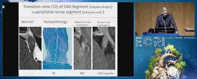 Histopathology Correlation Transition Zone