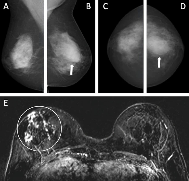 Using AI with mammography can help select women for breast MRI ...