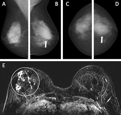 Images depict a 55-year-old woman with a family history of breast cancer who underwent combined mammography and MRI screening. (A) Right and (B) left mediolateral oblique and (C) right and (D) left craniocaudal mammograms show a large known cyst in the left breast (arrow in B and D), but were otherwise assessed as being unremarkable. Breast tissue was judged to be extremely dense. (E) Concurrent axial subtraction MRI scan shows a large, diffuse, invasive lobular cancer (circle) in the right breast. The AI system provided a case-based cancer suspicion score of 8 on a scale of 0-10, which would have led to selection for MRI screening using both the score 5 and score 8 thresholds, but not the score 9 threshold.
