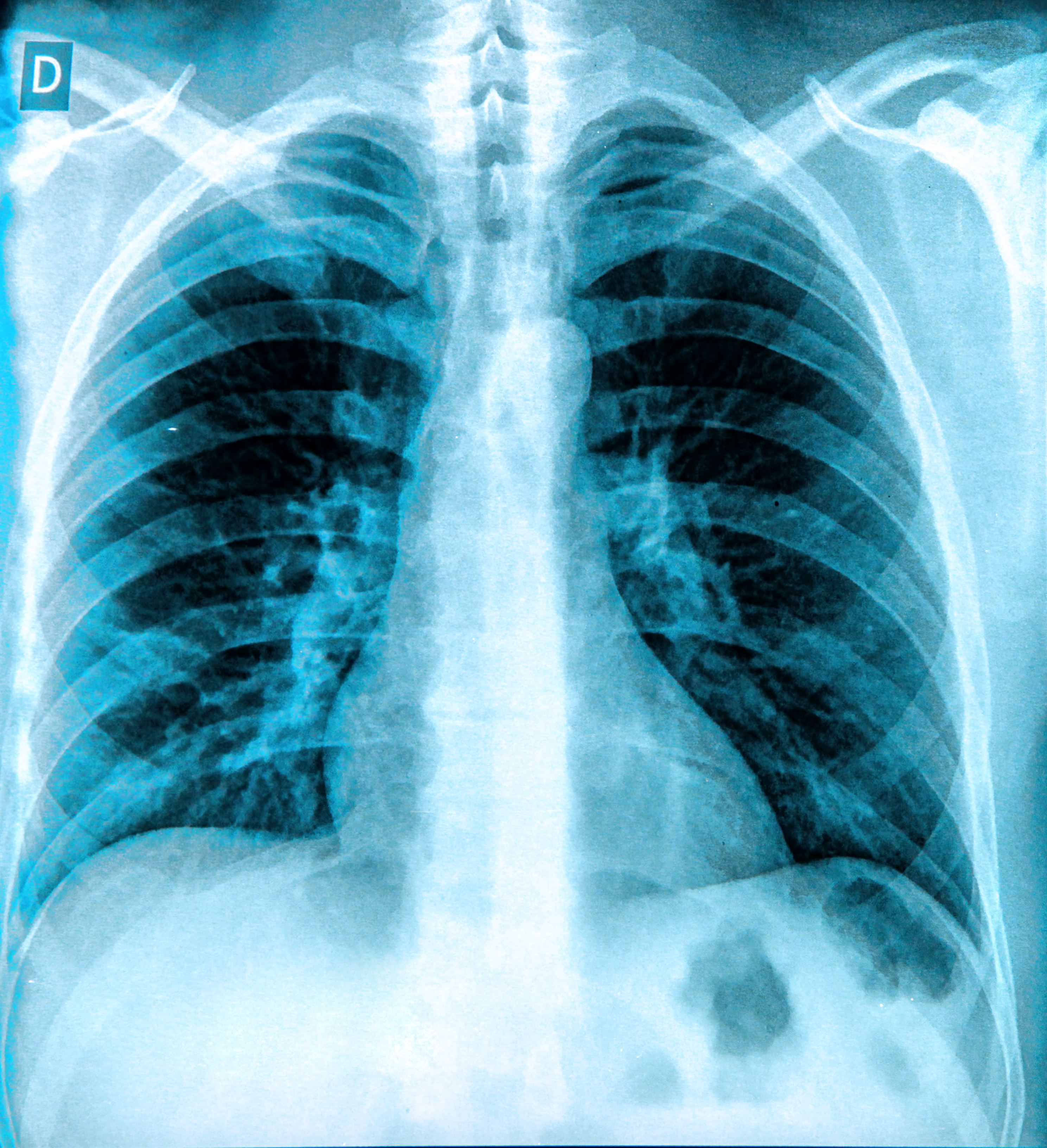 X Ray Chest Lungs