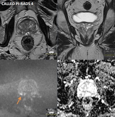 A 70-year-old asymptomatic man had a prostate-specific antigen (PSA) level of 2.67 in 2013, 3.13 in 2018, and 6.38 on August 2021. He had a Gleason Score of 3+4 pT3a, R1 left apex margin. Multiparametric MRI was performed on a 1.5 tesla scanner. Prostate volume was 33 cc and PSA density was 0.19. Peripheral zone (PZ): patchy intermediate signal bilaterally with a 6 mm focus of restricted diffusion and early enhancement in the right posterior base (see annotated images), PI-RADS 4 / LIKERT 4. Transition zone (TZ): no suspicious focal lesions. Extraprostatic extension: not evident. Seminal vesicles: normal. Lymph nodes: none enlarged. Bones: no suspicious focal lesions. Incidental finding: 12 mm polypoid lesion in the mid to lower rectum (annotated image) will require colorectal review and endoscopic correlation. Conclusion: small PI-RADS 4 lesion in the right posterior PZ will require a targeted biopsy. If malignancy is proven histologically, suggested radiological staging would be T2N0Mx. Figure courtesy of Prof. Anwar Padhani, from 'AI - Human Workflows NoteBookLM' podcast.