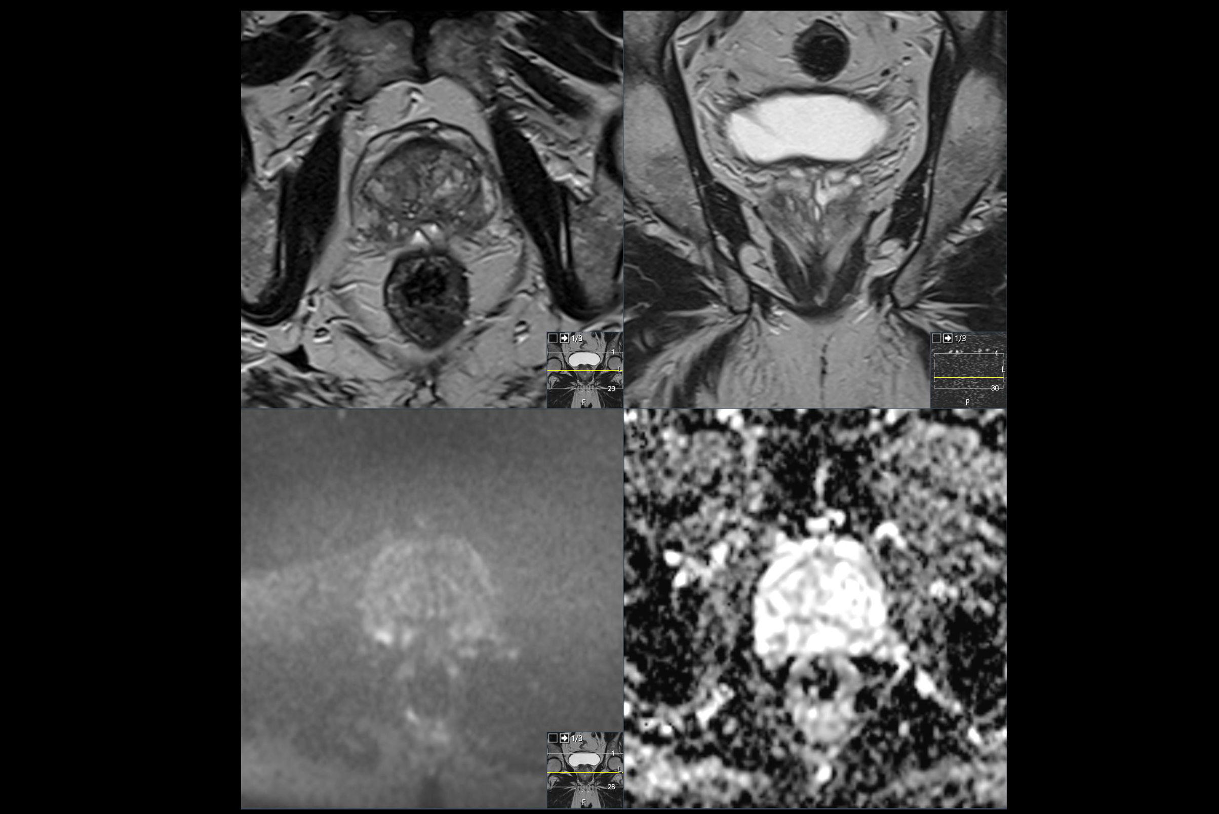 2025 03 13 Prostate Ai Radiologist Interactions Slide4 Thumbnail