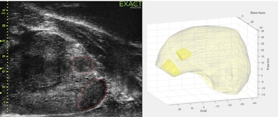 Images show the measurement of microultrasound prostate and tumor volume using ExactVuTM dedicated software. Images are available for republishing under a Creative Commons license (CC BY 4.0).