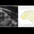 2025 03 14 Micro Ultrasound Prostate Thumbnail 67d470b3201c3