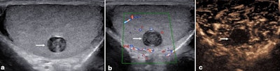 Epidermoid cyst. A 19-year-old man with a history of nonspecific pain was found on ultrasound (a) to have an incidental lesion in the left testis (arrow) with features suggesting an epidermoid cyst. There was no color Doppler (b) signal in the lesion (arrow). On the contrast-enhanced ultrasound (c) exam, there was no vascularity within the lesion (arrow).