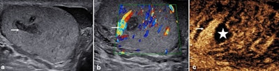 Scrotal trauma. After a 45-year-old man underwent sperm retrieval from the left testis for management of infertility, he presented with continuing pain following the procedure. The B-mode ultrasound (a) demonstrated a serpiginous low reflective area in the mid aspect of the testis (arrow). On the color Doppler examination (b), some shunting of blood (arrow) was visible to the lateral aspect of the low reflective area. On the contrast-enhanced ultrasound examination (c), the shunt was again noted (arrow) and the area of hematoma formation was visible (star). All figures courtesy of Dr. Faiz Jabbar, Dr. Dean Huang, and Prof. Paul Sidhu and presented at ECR 2025.