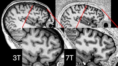 Comparison showing 3-tesla and 7-tesla scans for the same participant. Image courtesy of P Simon Jones, PhD, of the University of Cambridge.