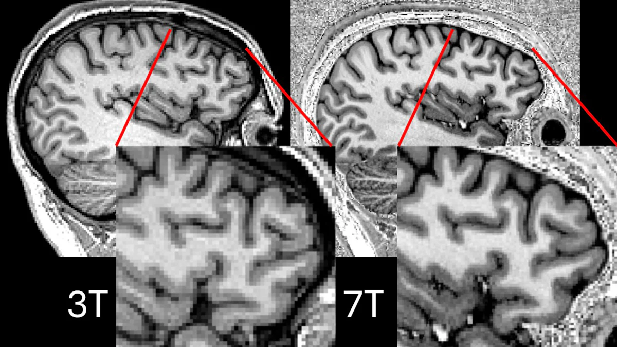 Revolutionary MRI Technique Boosts Epilepsy Treatment Success Rate