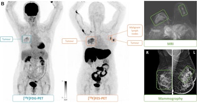 (B) F-18 FDG-PET maximum intensity projection, F-18 FES-PET maximum intensity projection, breast MRI scan, and mammogram in an 81-year-old female participant who presented with a tumor in the right breast. F-18 FES-PET scan shows a second primary tumor (grade 1, lobular) in the left breast and malignant lymph nodes (T2N1M0) that are not visible on the F-18 FDG-PET scan. The tumor in the right breast (T4N0M0, grade 3 ductal carcinoma) is visible on both PET scans. All lesions had also been identified at mammography and MRI. Image and caption courtesy of the RSNA.