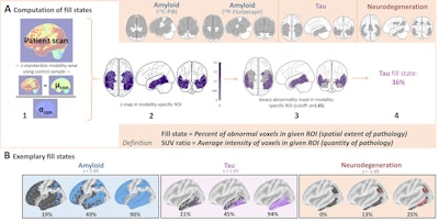 Schematic illustrates how fill states are derived. (A) Derivation of an exemplary tau fill state. Note that different meta-regions of interest (ROIs) were recommended for the assessment of amyloid PET markers from carbon-11 Pittsburgh compound B (C-11 PiB) and F-18 florbetapir The bottom beige box provides definitions for the two distinct concepts of fill states and standardized uptake value (SUV) ratios. (B) Surface plots corresponding to exemplary fill states for amyloid, tau, and neurodegeneration. The gray-shaded area indicates the meta-ROI, and the colored area indicates abnormal voxels. Color coding: blue = amyloid, purple = tau, red = neurodegeneration. Con = control. Image and caption courtesy of RSNA.