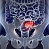 Am 2021 10 04 18 46 2240 Colorectal Cancer 400