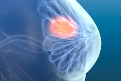 Breast Cancer3