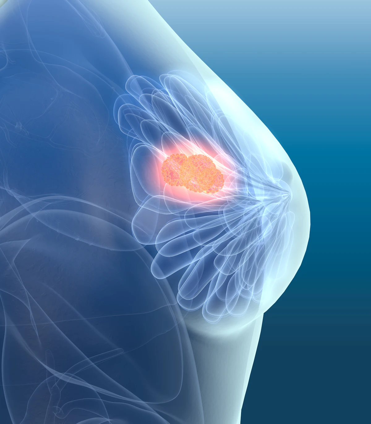 AI Mammogram Analysis Raises Concerns Over Cancer Detection