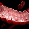 Colon Polyps 400