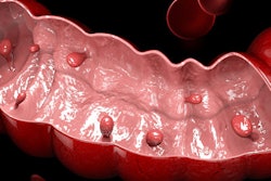 Colon Polyps 400