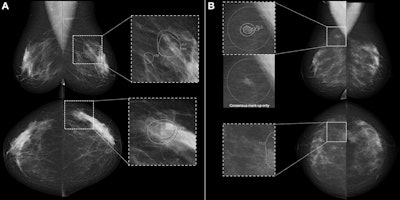 Full-field digital screening mammograms in participants recalled by the consensus discussion after being flagged by artificial intelligence (AI) computer-aided detection (CAD) but not by either of the two radiologists. (A) Mammogram with AI CAD score of 73 for a 55-year-old woman diagnosed with grade 3 in situ cancer and T1 (9-mm) invasive cancer in the left breast and lymph node metastasis. (B) Mammogram with AI CAD score of 54 for a 49-year-old woman diagnosed with grade 2 in situ cancer and T1 (6-mm) invasive cancer in the right breast and without lymph node metastasis. All images and caption courtesy of the RSNA.