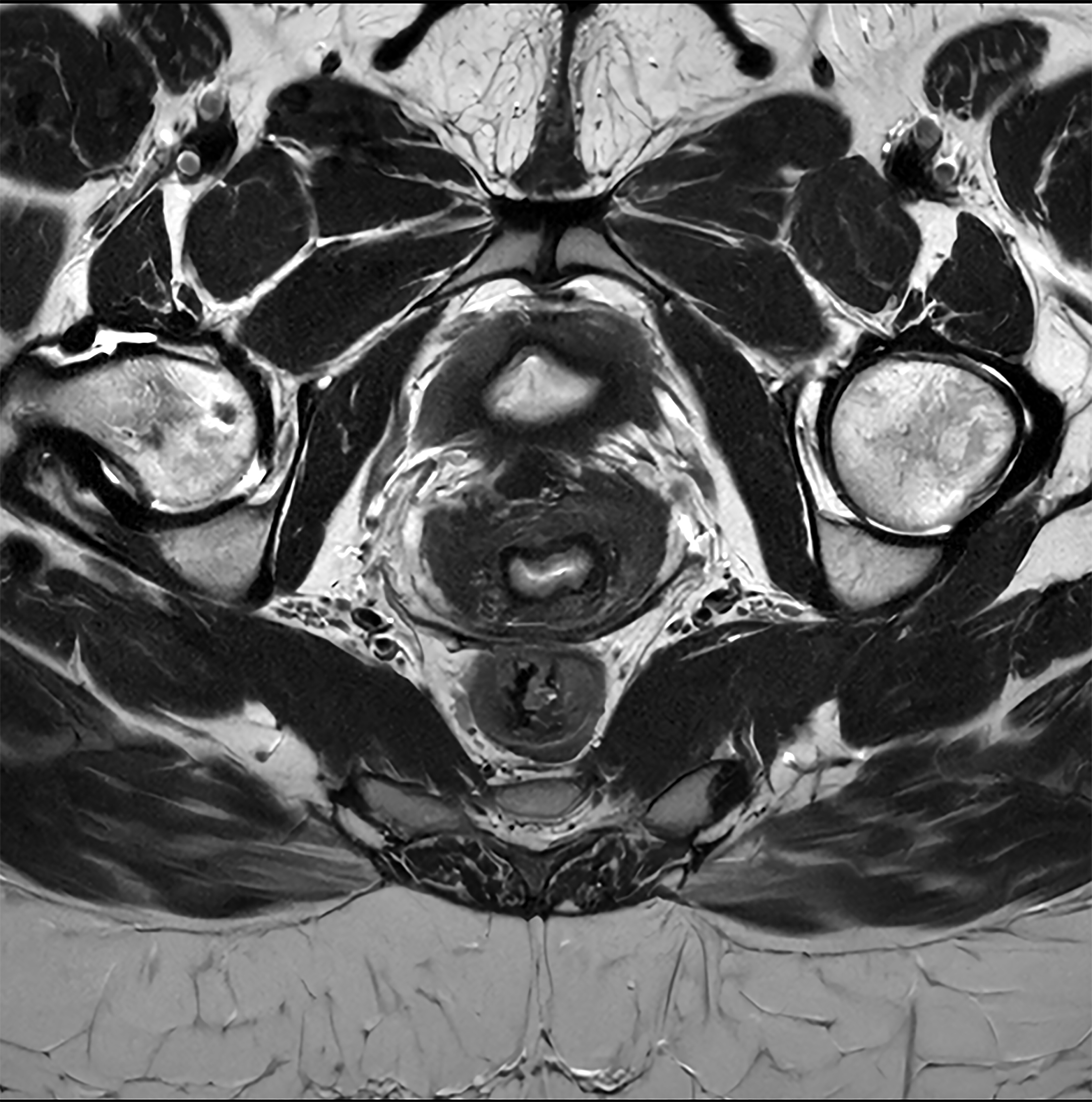 Clinical pelvis image acquired on a Ingenia Evolution 3-tesla scanner and reconstructed using Philips' SmartSpeed Precise AI-based image reconstruction technology. Image courtesy of Philips.