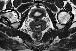 Clinical pelvis image acquired on a Ingenia Evolution 3-tesla scanner and reconstructed using Philips' SmartSpeed Precise AI-based image reconstruction technology. Image courtesy of Philips.
