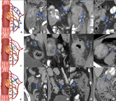 Schematic diagrams and representative images of different distribution patterns of region lymph nodes detected at CT. (A) Vascular distribution pattern: All regional lymph nodes detected at CT have regular borders and are distributed along the vessels (arrowheads). (B-E) Coronal CT images in a (B) 34-year-old woman, (C) 51-year-old man, (D) 37-year-old man, and (E) 40-year-old man with microsatellite instability-high (MSI-H) colon cancer show multiple clear lymph nodes distributed along the supplying arteries or draining veins (arrowheads). (F) Jammed cluster pattern: At least three lymph nodes with blurred margins and clustered (circle). (G-I) Coronal CT images in a (G) 29-year-old man, (H) 35-year-old man, and (I) 67-year-old man and (J) axial CT image in a 43-year-old man with MSI-H colon cancer show several lymph nodes with blurred margins and clustered (circle). Movies 1-4 provide more details. (K) Fused pattern: Several poorly defined lymph nodes clustered and fused together (arrow). (L-O) Coronal CT images in a (L) 63-year-old woman, (M) 59-year-old man, (N) 49-year-old woman, and (O) 73-year-old man with MSI-H colon cancers show several lymph nodes fused (arrow). Image courtesy of Radiology.