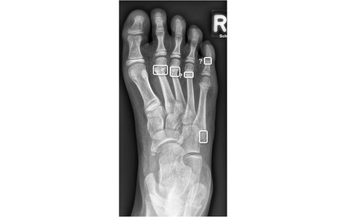 【超目玉枠】 improve can AI diagnosis fractures pediatric of ギター