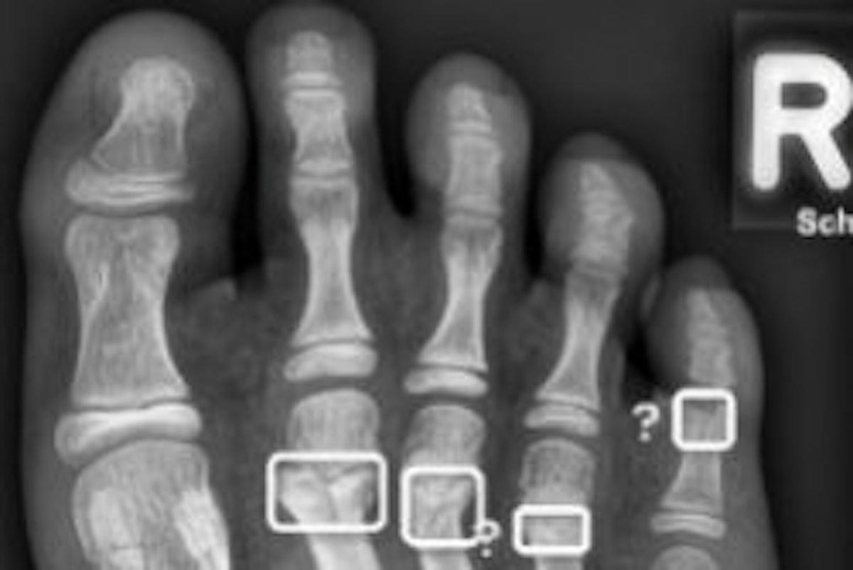 AI can improve diagnosis of pediatric fractures