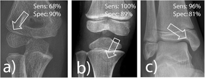 Frequently missed fracture entities with medicolegal significance according to van Laer. a Radial condyle fracture, (b) fracture of the proximal tibia, and (c) fracture of the medial malleolus. The lucency marked by an arrow indicates the fracture. Sens, sensitivity; Spec, specificity.