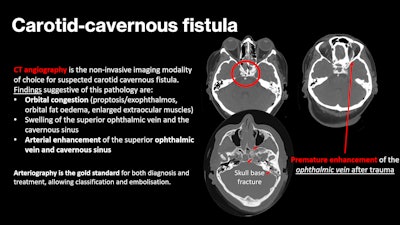 A 67-year-old patient was brought to the emergency department after severe trauma. The CT scan of the encephalon shows a left occipital fracture with extension to the petrous portion of the ipsilateral temporalis (longitudinal type). CT angiography of the cerebral arteries reveals early repletion of the arterial phase of the left superior ophthalmic vein, as well as several hyperdense foci in the left cavernous sinus (circle), indicative of a carotid-cavernous fistula. All figures courtesy of Dr. César Antonio López López et al and presented at ECR 2025.